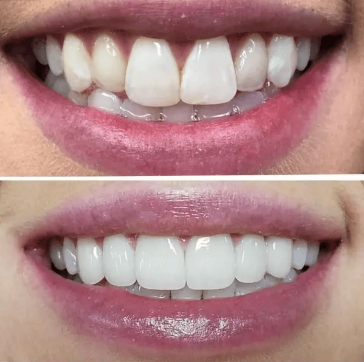 porcelain veneers leeds before after