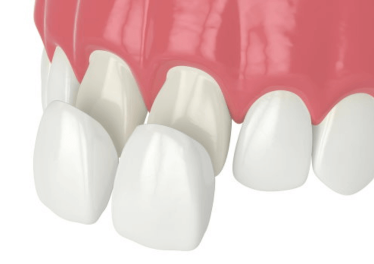 porcelain veneers leeds diagram