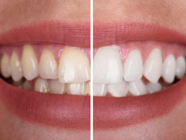 teeth whitening scholes leeds